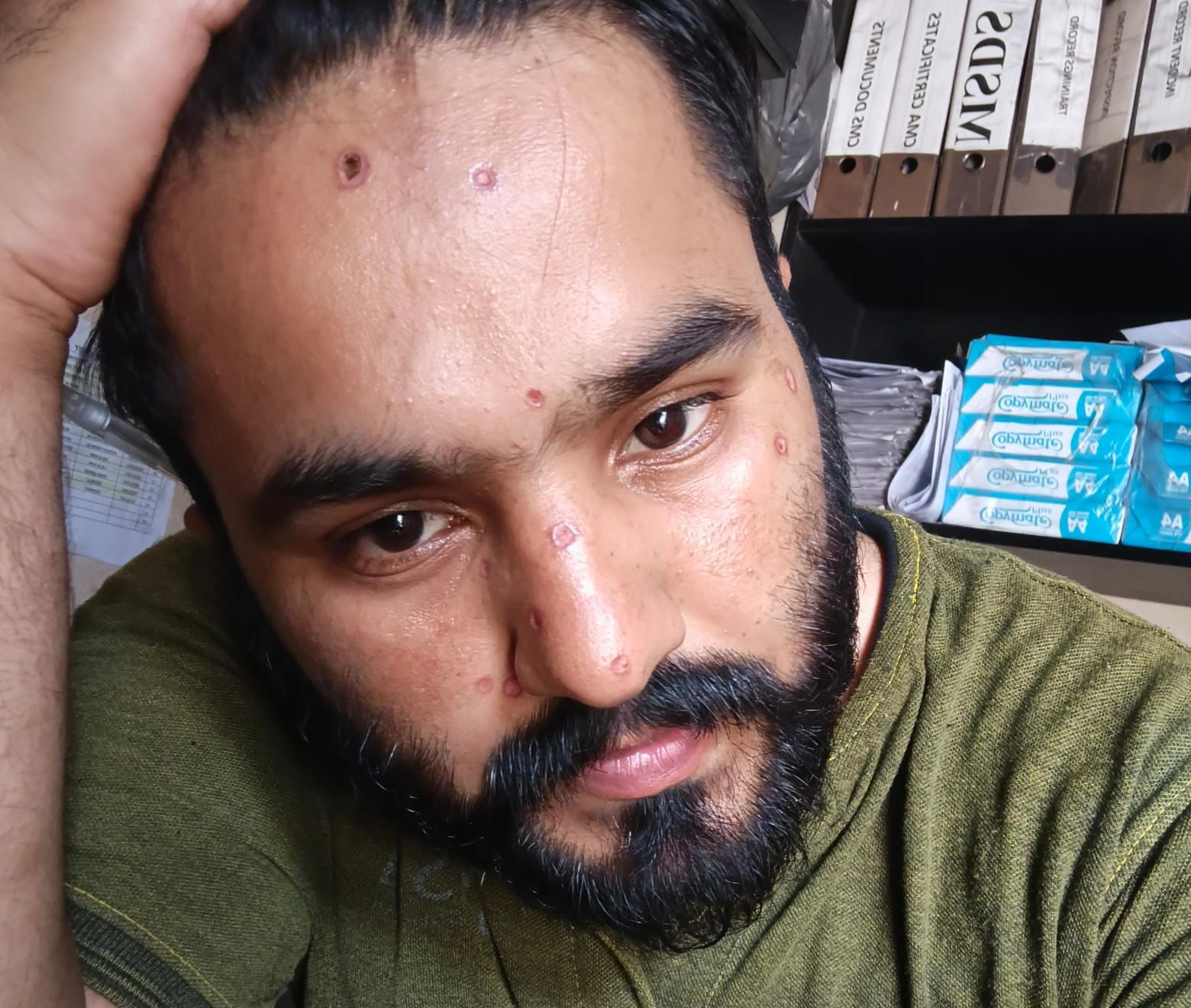 Customer before using Helosis Mole Cream