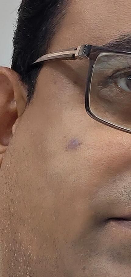 Customer after using Helosis Mole Cream