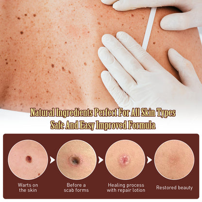 🧴Helosis Mole&Wart Remover Cream🤩