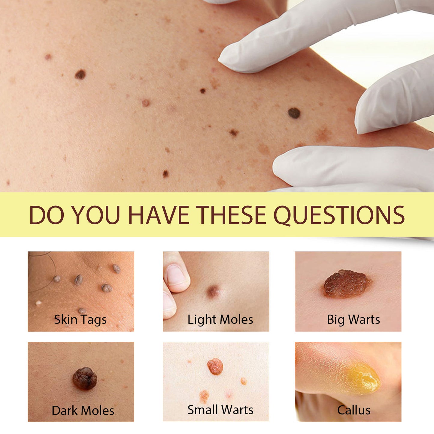 🧴Helosis Mole&Wart Remover Cream🤩