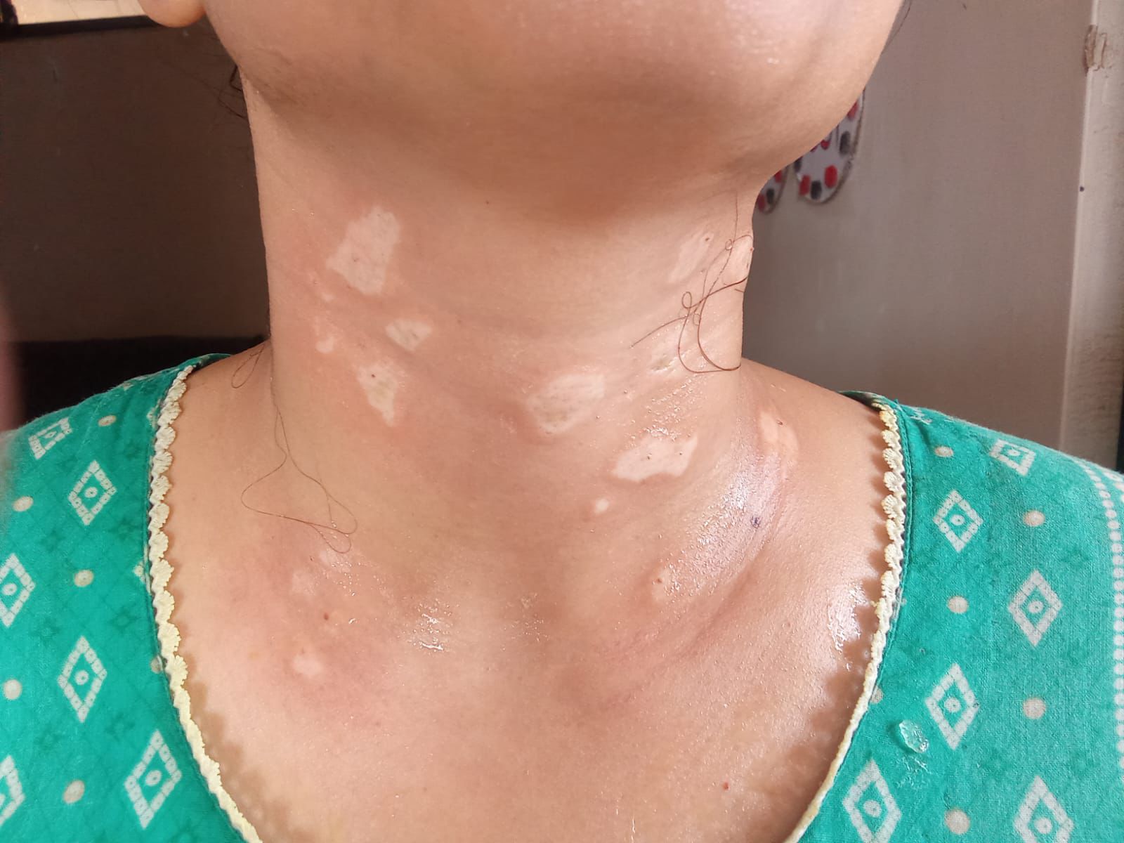 Cream applied on neck skin tags