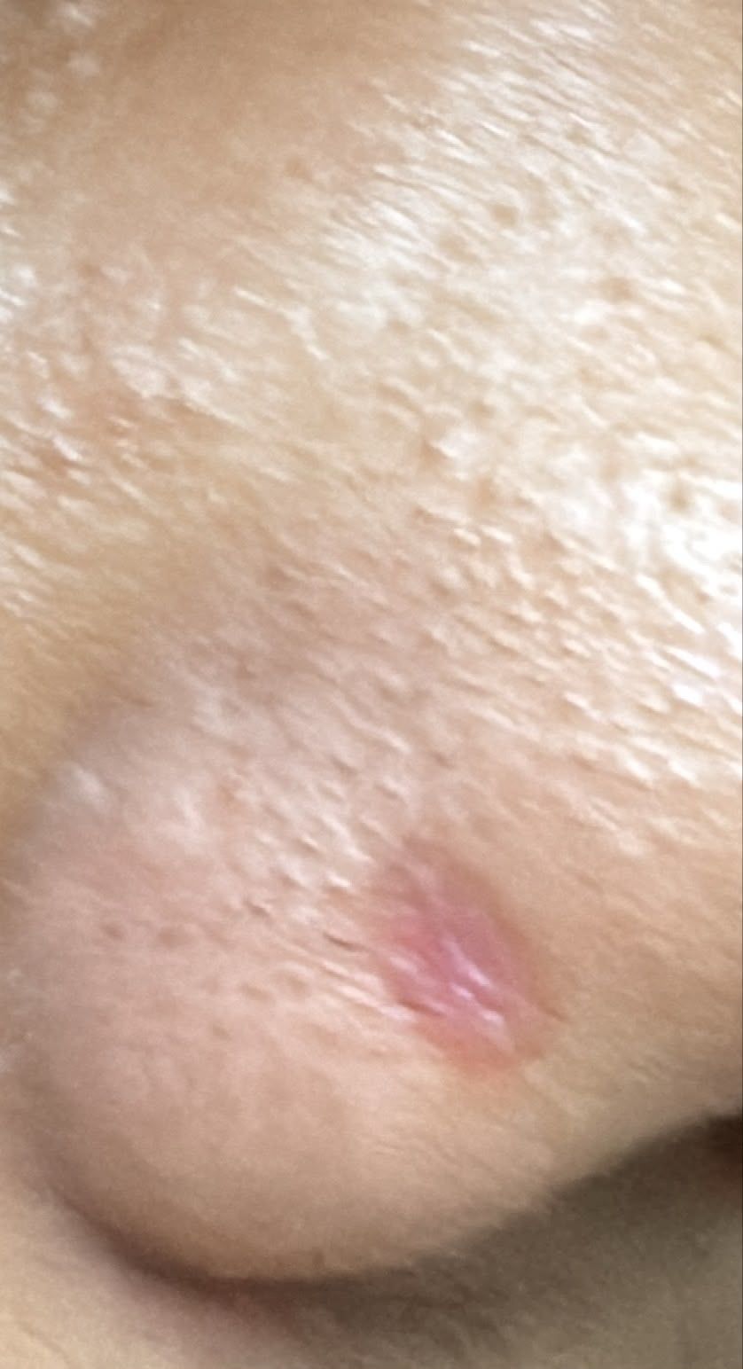 Close-up of skin healing